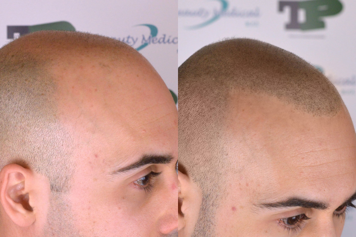 Découvrez tout sur la tricopigmentation : méthode, résultats, prix 2025, praticiens fiables, risques et alternatives. Guide expert complet.