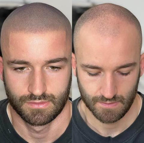 Évolution technique tricopigmentation