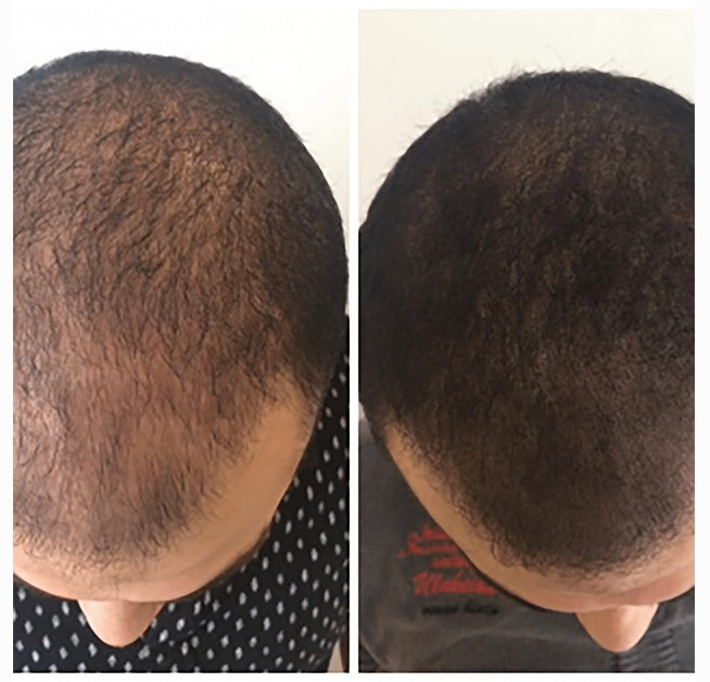 Pour qui est la tricopigmentation ?