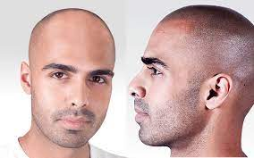 Découvrez tout sur la tricopigmentation : méthode, résultats, prix 2025, praticiens fiables, risques et alternatives. Guide expert complet.